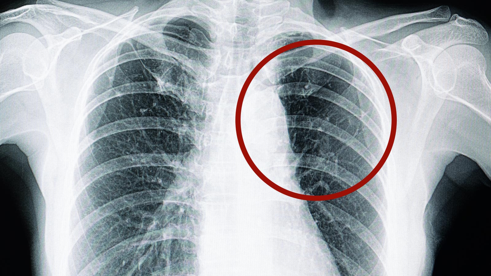 plumas ave y fibrosis pulmonar